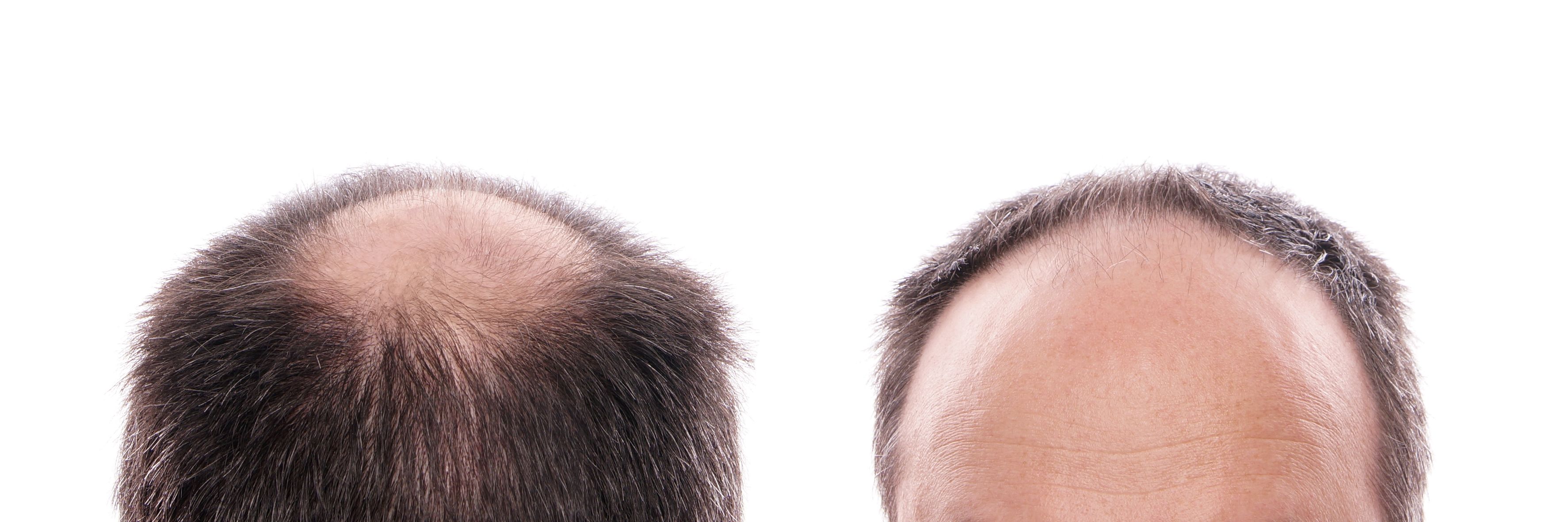 The Right Hair Restoration Center in Salt Lake City Might Be Right for You