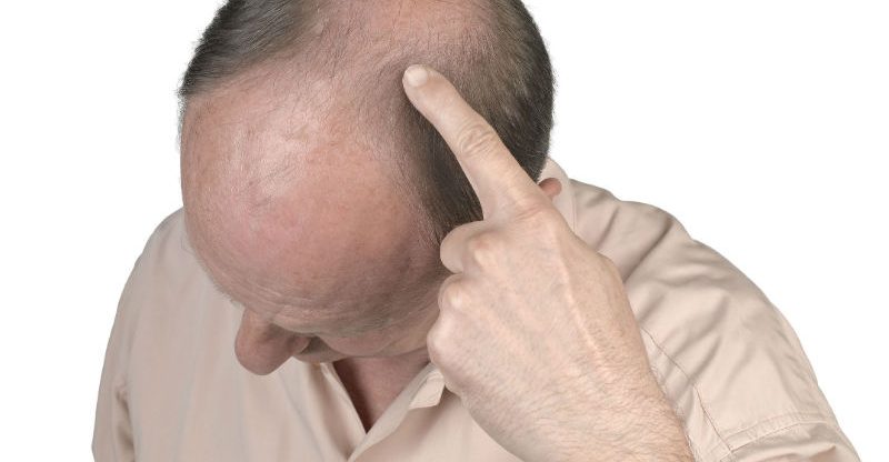 Common Questions People Ask About Hair Transplant In New Jersey