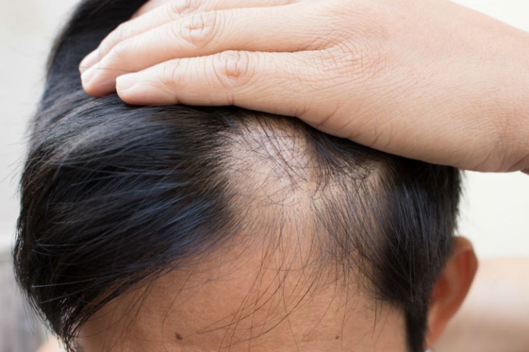 Get a New Lease on Life With a Hair Transplant in Connecticut