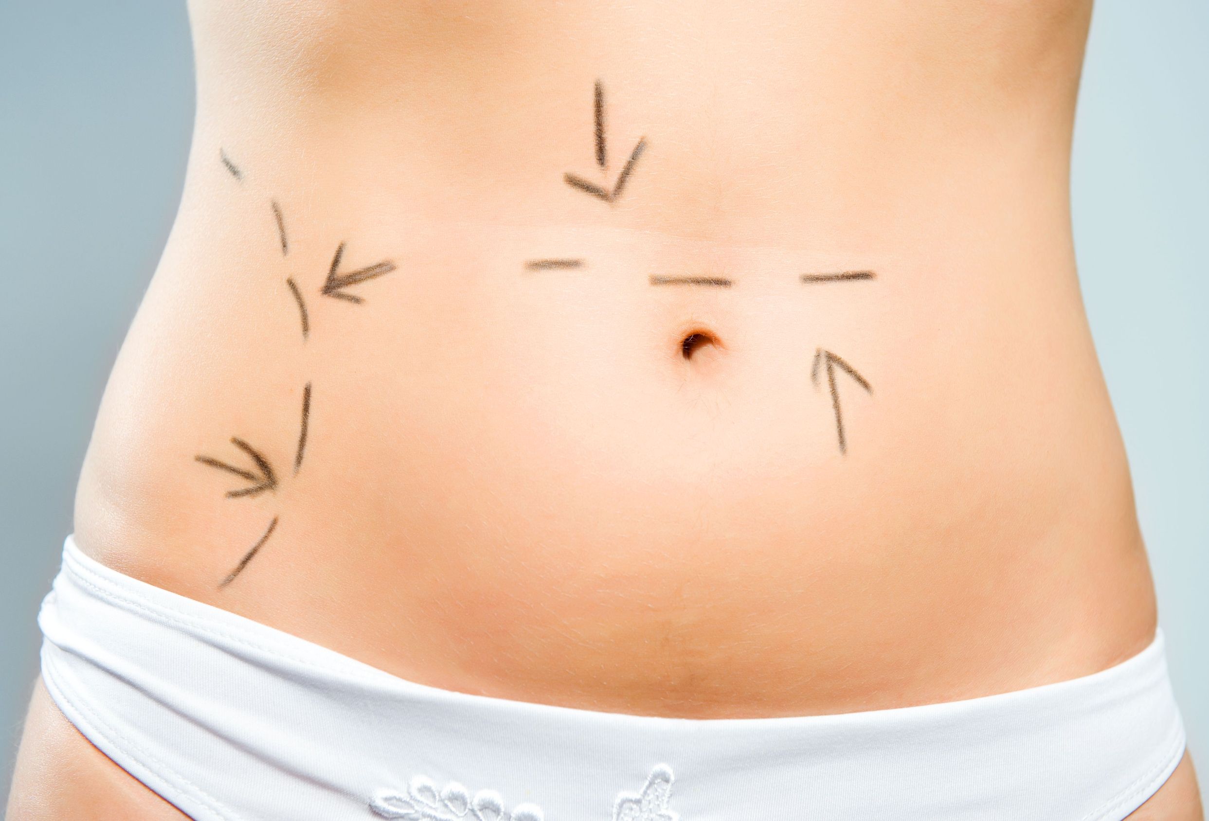 Try BodyTite Chicago: A Revolutionary Body Contouring Solution