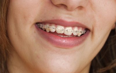 Say Hello To A New Smile With Braces In Strongsville, OH